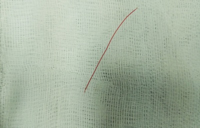 Phẫu thuật thành công trường hợp dị vật đâm thủng ruột non.